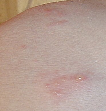 poison ivy rash pictures. minor poison ivy rashes. bad