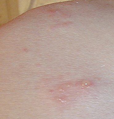 mild poison ivy rashes. Rash Picture