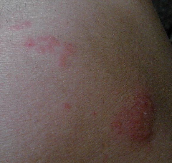 poison ivy rash pics. Back to the Poison Ivy