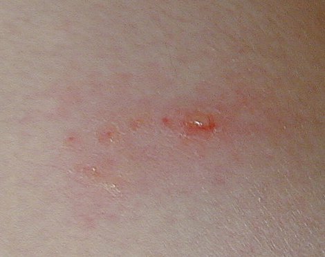 Rash Picture